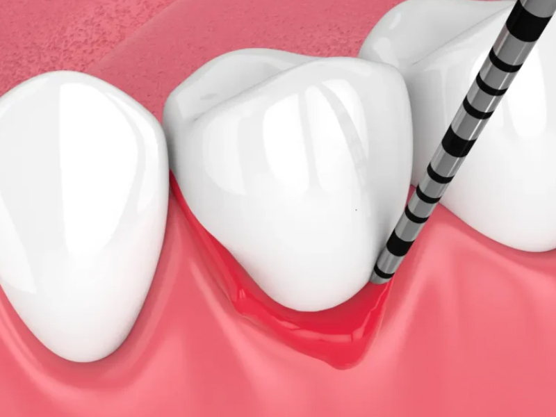 periodontal-dis-eti-ve-cene-kemigi-destek-grefti-jpg