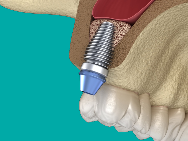 sinus-lifting-jpg