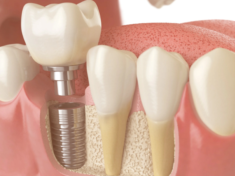 implant-kemik-grefti-jpg